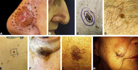 malignant melanoma in situ scalp icd 10